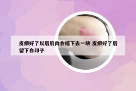 皮癣好了以后肌肉会缩下去一块 皮癣好了后留下白印子