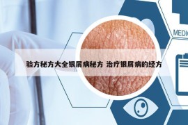 验方秘方大全银屑病秘方 治疗银屑病的经方