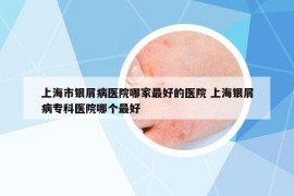 上海市银屑病医院哪家最好的医院 上海银屑病专科医院哪个最好