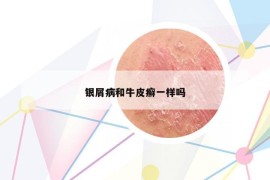 银屑病和牛皮癣一样吗