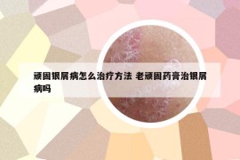 顽固银屑病怎么治疗方法 老顽固药膏治银屑病吗