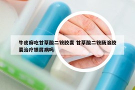 牛皮癣吃甘草酸二铵胶囊 甘草酸二铵肠溶胶囊治疗银屑病吗