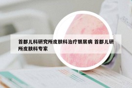 首都儿科研究所皮肤科治疗银屑病 首都儿研所皮肤科专家