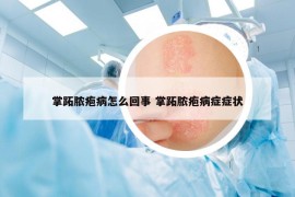 掌跖脓疱病怎么回事 掌跖脓疱病症症状