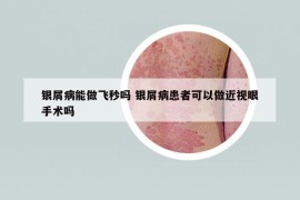 银屑病能做飞秒吗 银屑病患者可以做近视眼手术吗