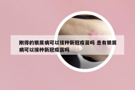 刚得的银屑病可以接种新冠疫苗吗 患有银屑病可以接种新冠疫苗吗