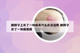 脚脖子上长了一块癣有什么办法治呢 脚脖子长了一块癣很痒