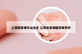 辽源银屑病华山选定 辽源皮肤病医院哪家好