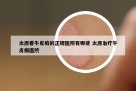 太原看牛皮癣的正规医院有哪些 太原治疗牛皮癜医院