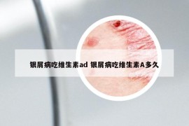 银屑病吃维生素ad 银屑病吃维生素A多久