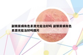 副银屑病有色素激光能治好吗 副银屑病有色素激光能治好吗图片