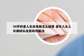 50岁的老人头皮有癣怎么回事 老年人头上长癣掉头皮屑如何解决