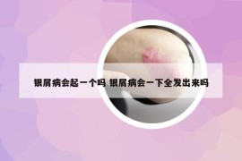 银屑病会起一个吗 银屑病会一下全发出来吗