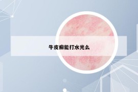 牛皮癣能打水光么