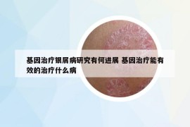 基因治疗银屑病研究有何进展 基因治疗能有效的治疗什么病