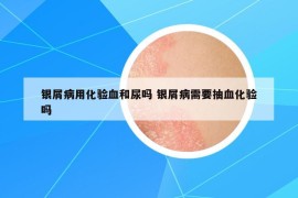 银屑病用化验血和尿吗 银屑病需要抽血化验吗