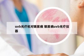 uvb光疗机对银屑病 银屑病uvb光疗仪器