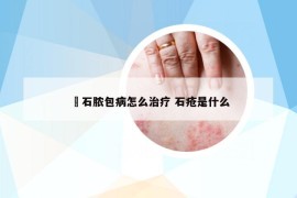 礃石脓包病怎么治疗 石疮是什么